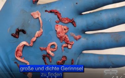 Faserige Gerinnsel und kalamariartige Strukturen (Amyloide) – Was Einbalsamierer seit 2021 beobachten