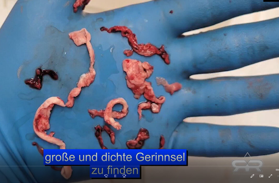 Faserige Gerinnsel und kalamariartige Strukturen (Amyloide) – Was Einbalsamierer seit 2021 beobachten